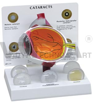 Cataract Eye